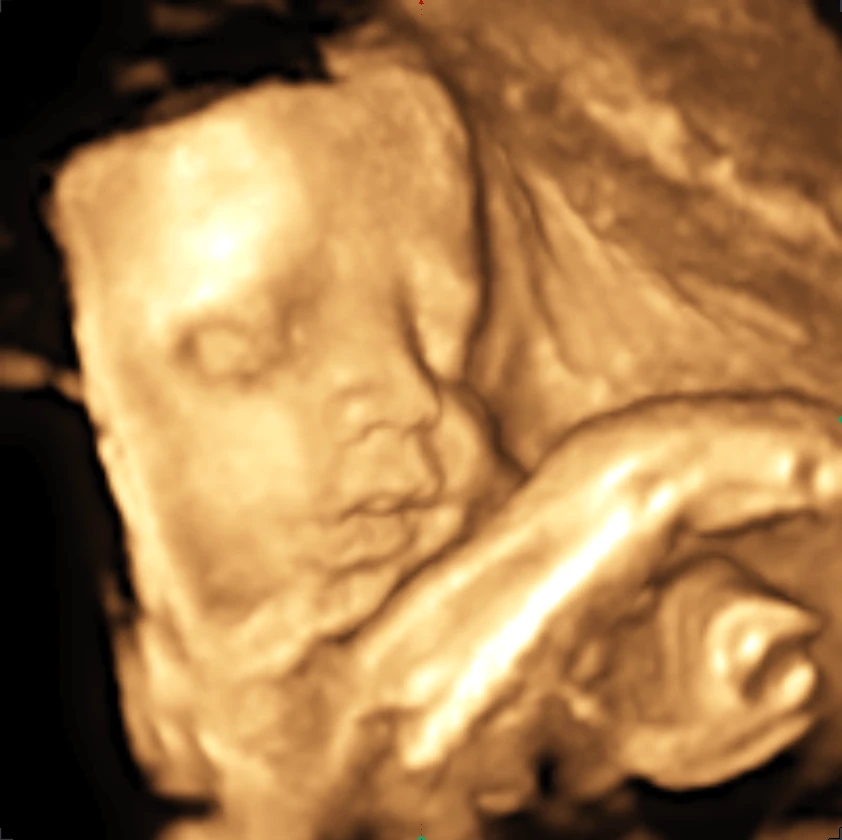 Beispielaufnahme einer 3D-Sonographie