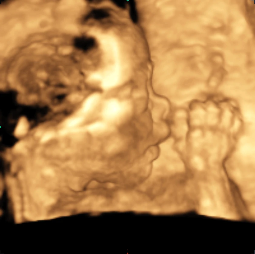 Beispielaufnahme einer 3D-Sonographie
