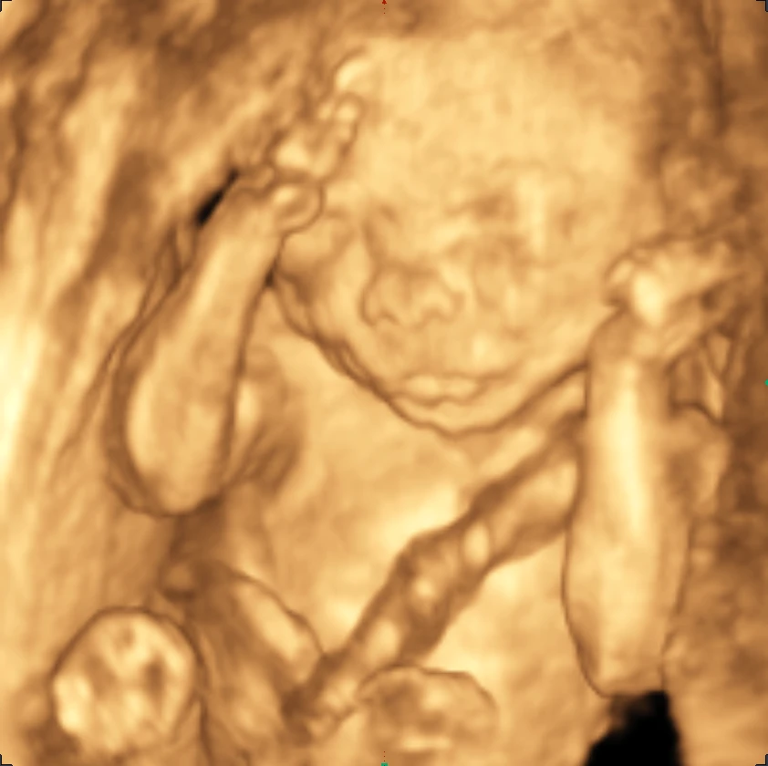 Beispielaufnahme einer 3D-Sonographie